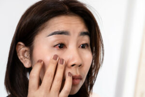 A picture of an Asian woman suffering from eye inflammation, feeling pain from a Pink Eye infection.