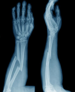 A broken arm xray result used for diagnosis and treatment in urgent care center.